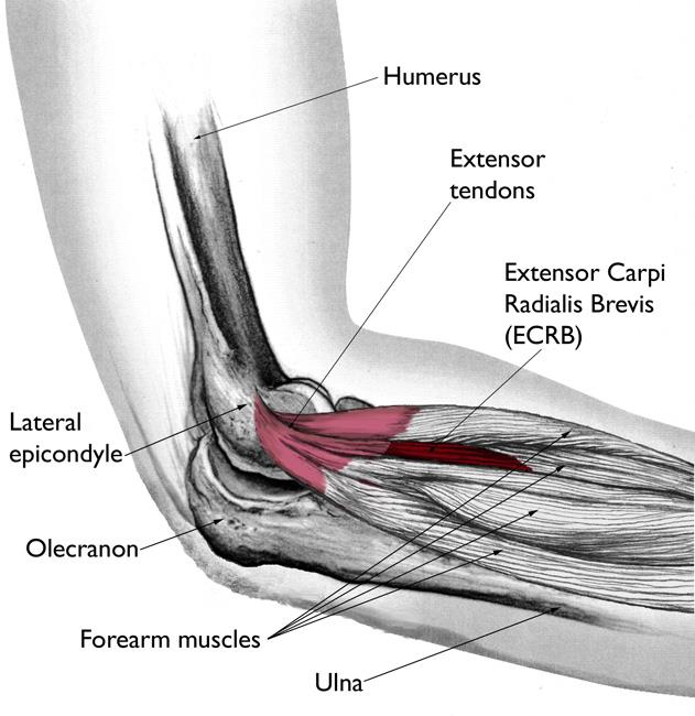 Chris Treat Tulsa Elbow Surgeon illustration showing the muscles and tendons involved in tennis elbow (lateral epicondylitis)