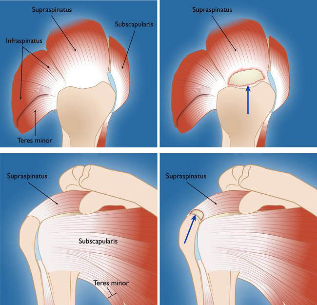 Chris Treat Tulsa Shoulder Surgeon Rotator Cuff muscles and tendons Illustration